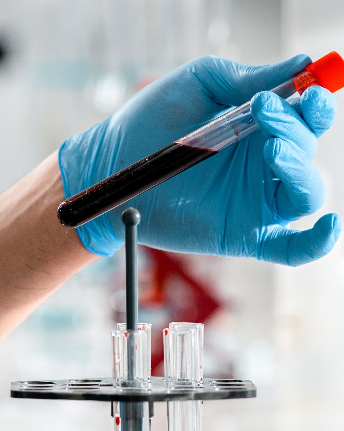 A blood sample in a test tube